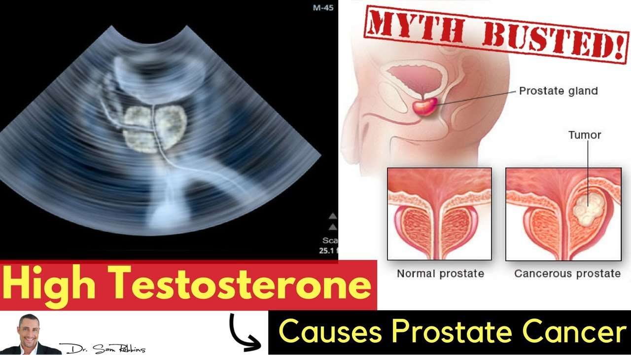 ð¤¼â?âï¸? MYTH: Testosterone Causes Prostate Cancer