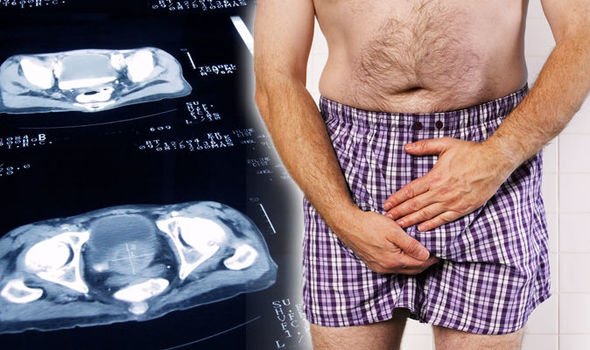 You Can See More: Prostate cancer symptoms: Do you have ...
